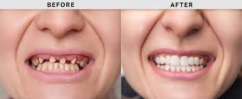 dental veneers in pragathi nagar